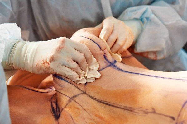 Qui est éligible à une abdominoplastie à Paris ?