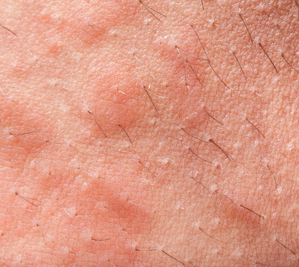 Eczéma visage : stratégies pour une peau en pleine santé